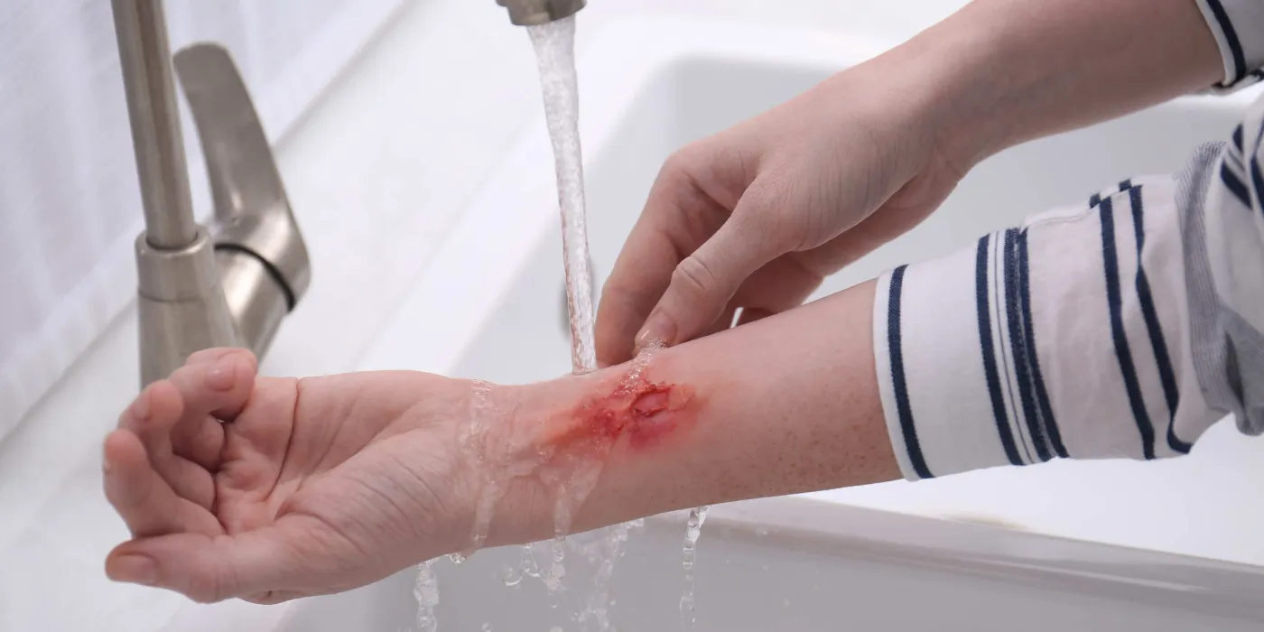 Come capire se una ferita è infetta: sintomi, segnali e cosa fare