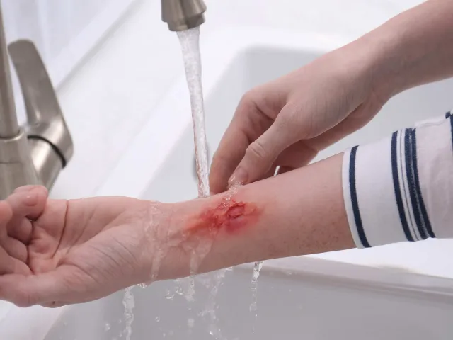 Come capire se una ferita è infetta: sintomi, segnali e cosa fare